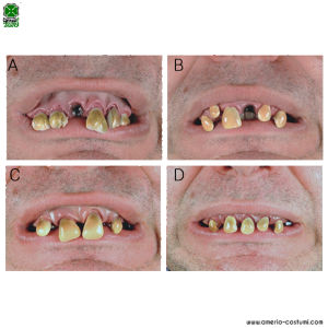 DENTIERA SCHIFOSA - disp. 4 mod.